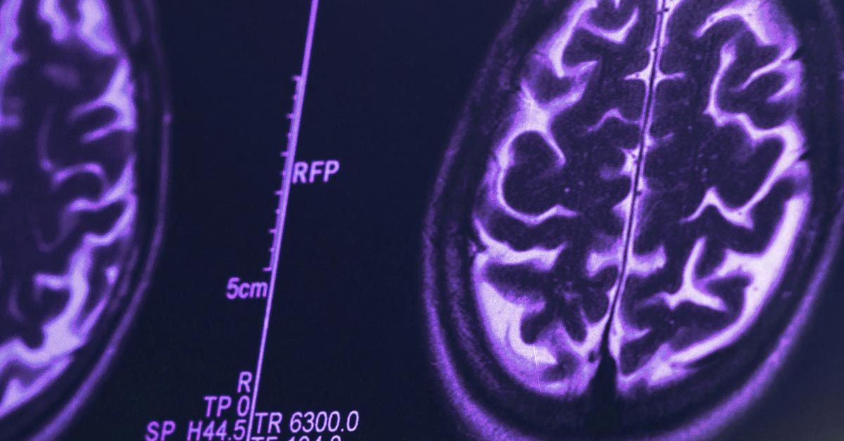 Rethinking Alzheimer’s image